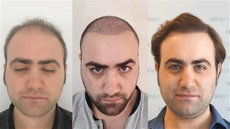 haartransplantation türkei hermest|hair transplant in turkey.